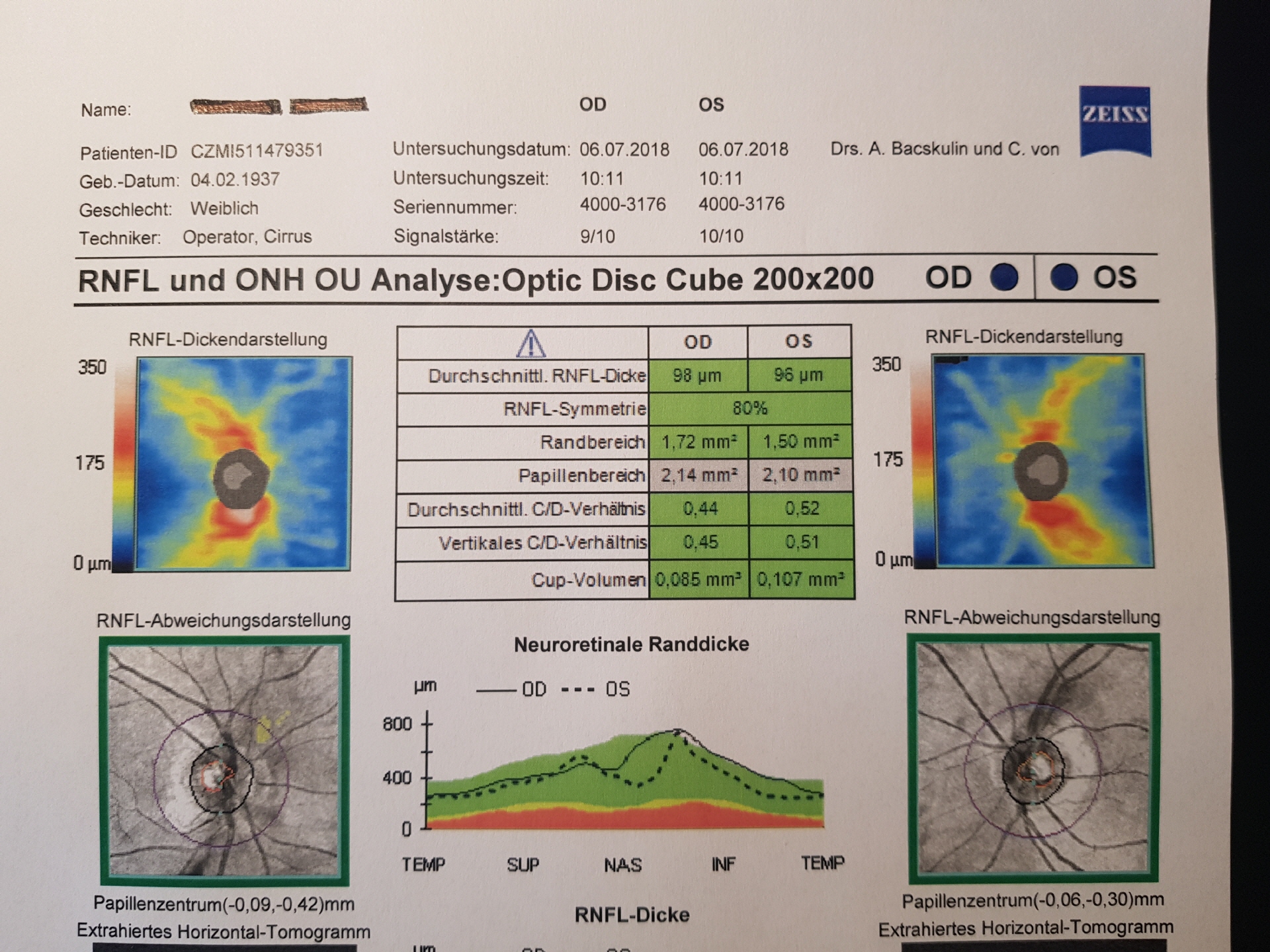 Präzisonsvermessung des Sehnerves